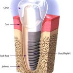 implant2