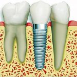 implant3